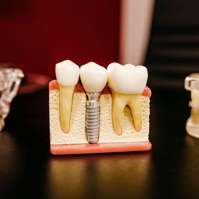 Dental-Implant-2 Dental-Implant-2
