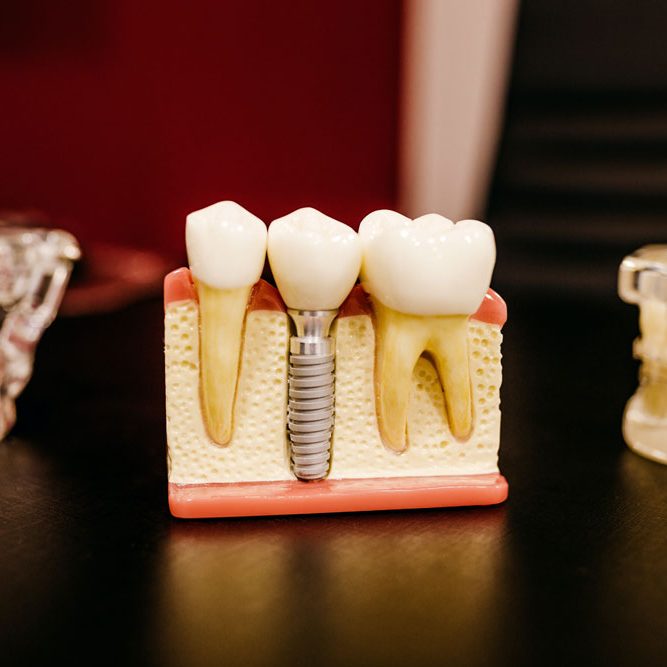 Dental-Implant-2